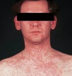 An image showing a person with measles. The rash is across their neck and shoulders
